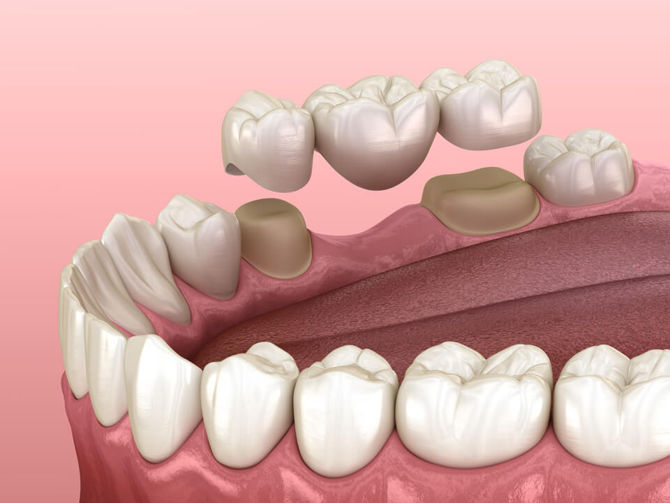 dental.bridge 2 Vaccaeo Aesthetic