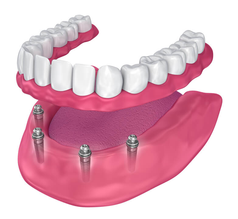 implant.denture 1 Vaccaeo Aesthetic