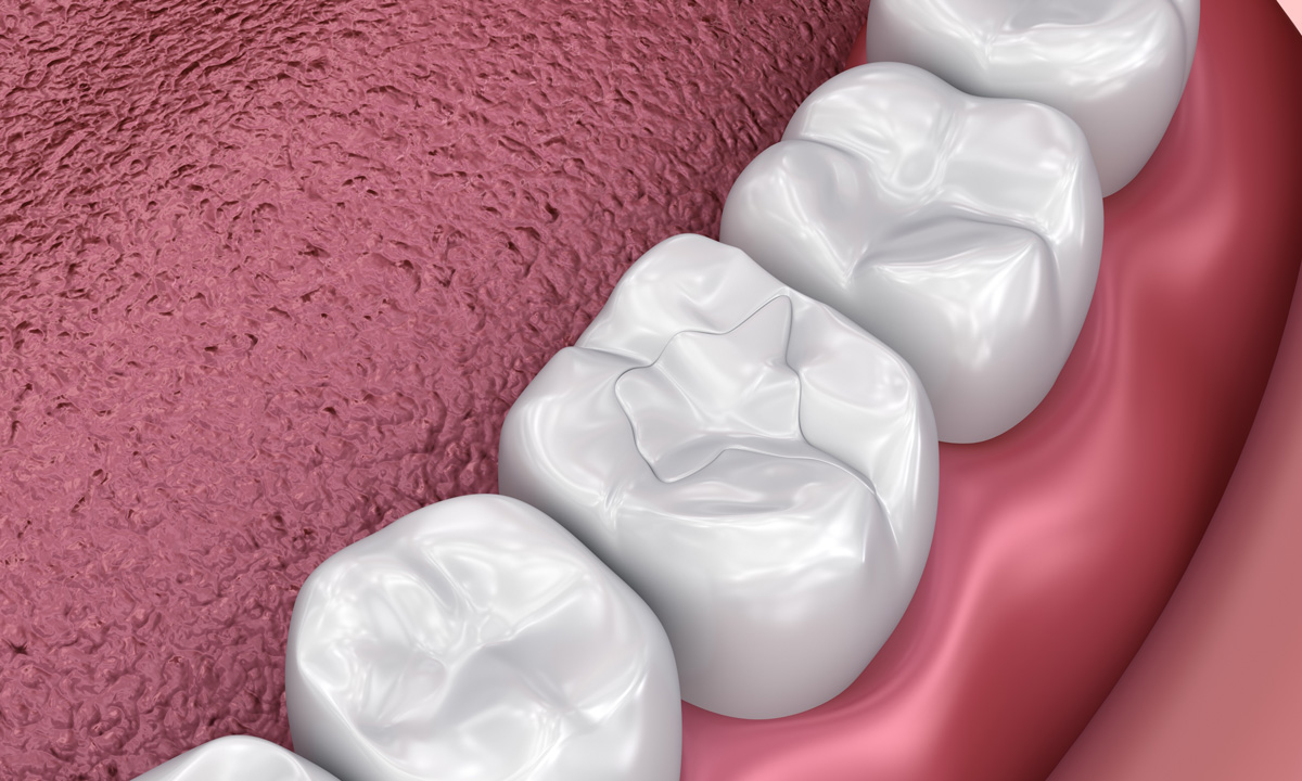 toothcolored.fillings 2 Vaccaeo Aesthetic