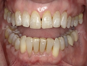 The image depicts a person with a wide grin revealing numerous yellowed teeth and gums, which suggests poor dental hygiene.