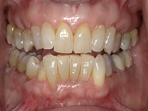 The image shows a close-up of an individual's mouth with yellowed teeth and gums, indicating possible dental issues such as discoloration or decay.