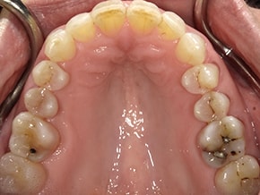 The image shows a close-up view of an open mouth with visible teeth and gums, revealing a dental implant and surrounding oral structures, set against a blurred background that appears to be a medical setting.