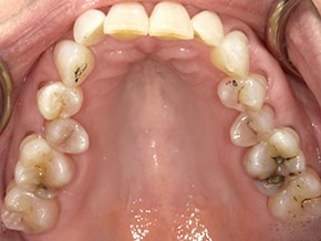 The image shows an open mouth with teeth and gums, revealing a dental situation where some teeth are missing, and there appears to be decay and possible infection around the remaining teeth.