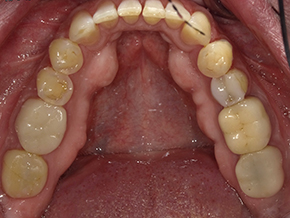 The image shows an open mouth with multiple teeth missing, gum disease evident, and yellow staining on the teeth.