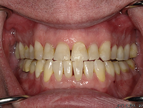 The image shows a close-up view of a person s mouth with yellowed teeth, some of which are missing, and a red gumline. The person appears to be wearing braces and has a visible metal wire in their mouth. The individual has an expression that could be interpreted as smiling or grimacing.