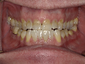 The image features a close-up view of a person s mouth with severe dental decay, showing yellowed teeth and an open mouth with visible gum disease.
