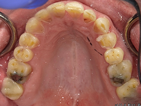 The image shows a close-up view of an open mouth with visible teeth and gums, and there are rings around the teeth, suggesting that the person may have had dental work done.