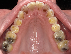 The image shows a close-up view of a person s mouth with yellow teeth and an open tongue, revealing numerous dental issues including cavities and possible infection, with a focus on the lower front teeth.
