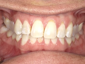 The image shows a close-up view of a person s mouth with teeth, gums, and tongue visible against a neutral background.