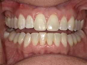 The image shows a close-up view of an open mouth with yellowed teeth, which appears to be a dental implant with a white crown.