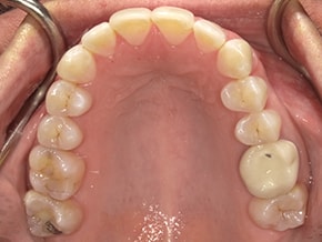 The image shows an open mouth with teeth and gums, displaying a dental implant with visible screws, likely taken from a medical or dental context for educational purposes.