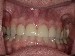 The image shows a close-up view of an open mouth with teeth and gums, revealing signs of dental work such as crowns and fillings.