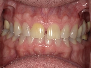 The image shows a close-up view of an open mouth with yellowed teeth and visible gum disease, indicating poor oral hygiene.