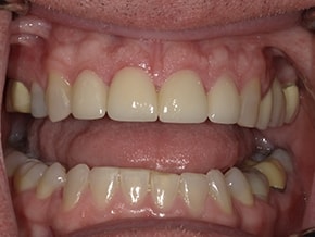 The image features a close-up view of an open mouth with multiple yellowed teeth showing signs of decay and wear, set against a darker background.