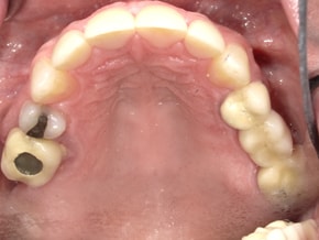 The image shows an extreme close-up of a person s mouth with teeth, gums, and tongue visible, displaying a dental issue that includes missing teeth and possibly infection or decay.