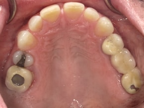 The image shows a close-up view of a person s mouth with multiple teeth missing and some remaining teeth showing signs of decay, along with an object resembling a toothbrush stuck between the teeth.