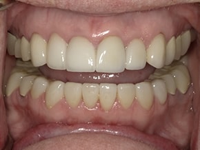 The image shows a close-up view of a person's mouth with teeth that appear yellowed and stained, likely due to tobacco use, set against a neutral background.
