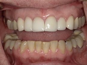 The image shows a close-up view of an open mouth with a set of yellowed teeth and gums, displaying some tooth decay and staining.