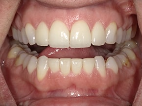 The image shows a close-up view of an open mouth with teeth, likely for dental health or cosmetic purposes.