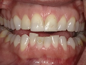 The image shows a close-up view of an individual's mouth with teeth showing signs of decay and discoloration, and there appears to be a dental implant on the upper left side.