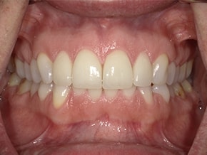 The image shows an open mouth with white teeth and visible tongue, set against a backdrop that appears to be a person's chin and neck.