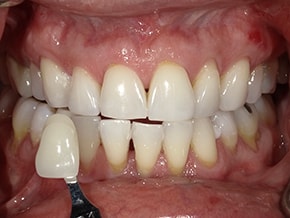 The image shows a close-up view of a person's mouth with teeth that appear to be discolored or stained, possibly due to dental issues such as decay or gum disease. There is a toothbrush in the lower right corner of the mouth, suggesting an attempt at cleaning or maintenance.