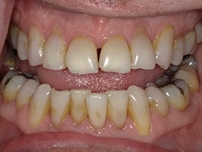 The image shows a close-up view of a person s mouth with yellowed teeth and gums, displaying signs of dental decay and poor oral hygiene.