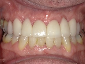 The image shows a close-up view of a person s mouth with a wide smile revealing yellowed teeth and gums, which appear inflamed.