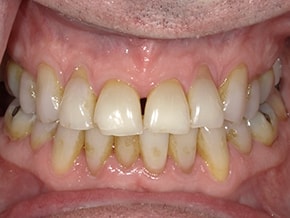 The image shows a person s teeth with yellow stains, possibly indicating poor oral hygiene or a medical condition.