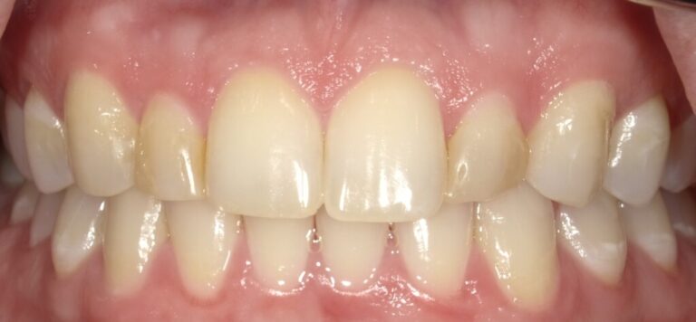 The image shows a close-up view of a person's teeth with yellow staining, likely from tobacco use, against a blurred background.