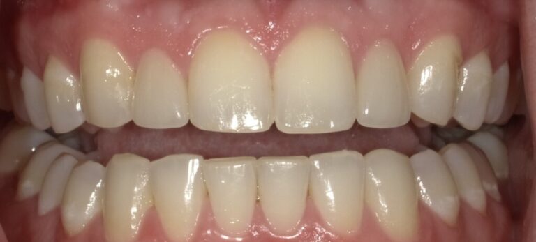 The image shows a person s mouth with teeth showing, featuring a bright smile with white teeth and gums, against a plain background.