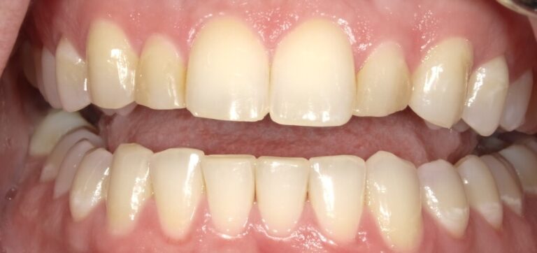 The image shows a close-up view of a person s teeth with yellow stains, which suggests poor oral hygiene.