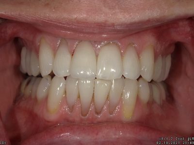 The image shows a close-up view of a person's teeth with braces, revealing a smile with white teeth and gums.