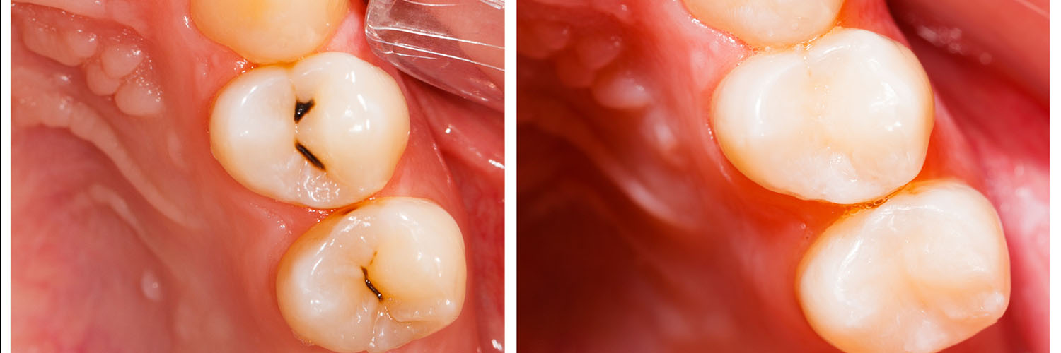 The image shows a close-up view of a person s mouth with teeth, gums, and a partial tongue visible, highlighting dental health or oral care.
