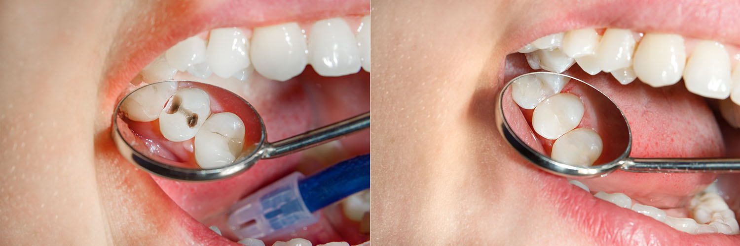 The image shows two photos of a person with a toothbrush in their mouth, revealing a cavity during a dental appointment.