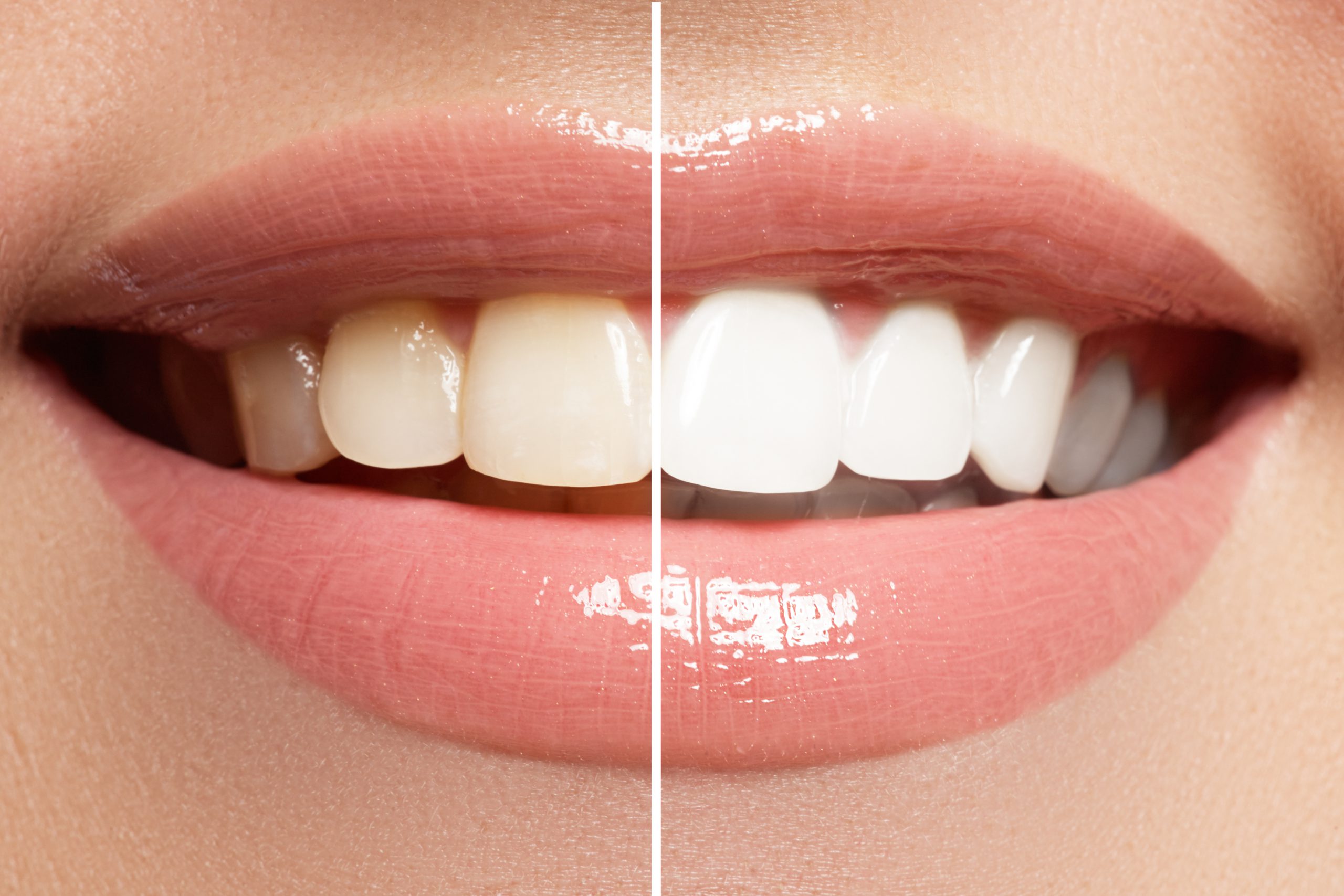teeth whitening scaled Vaccaeo Aesthetic