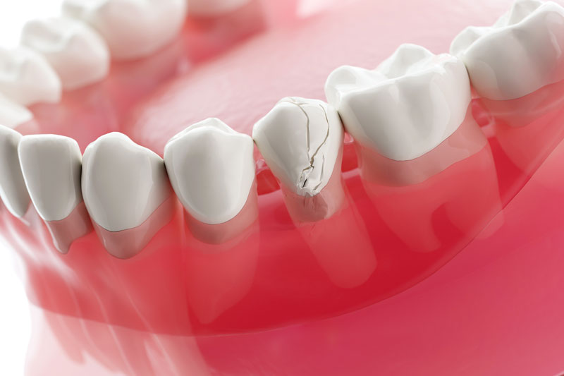 3d model cracked tooth Vaccaeo Aesthetic
